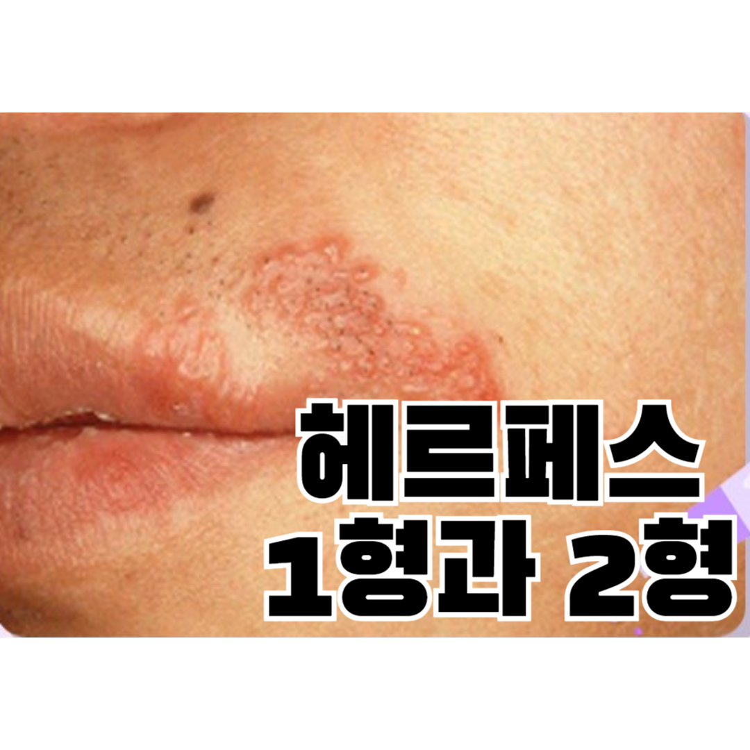 헤르페스 2형 성병-증상, 전염 경로, 예방 방법 알아보기 | bisangstory