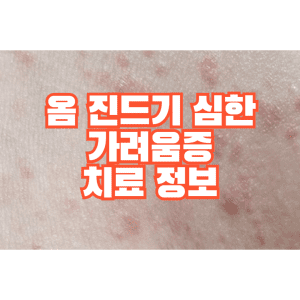옴 진드기 심한 가려움증,치료 정보